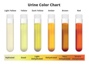 If Your Urine Looks Like This, Go to the Hospital Immediately
